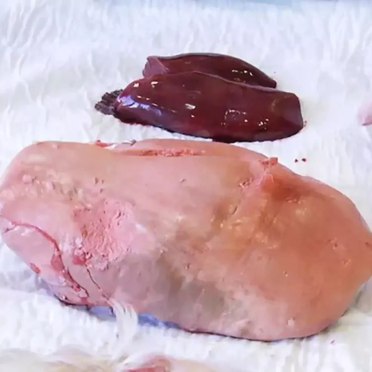 Fettleber im Vergleich zu einer gesunden Leber